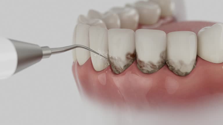 Reliable Dental Implants contractor in Sanibel, FL by Smile Center Dentistry